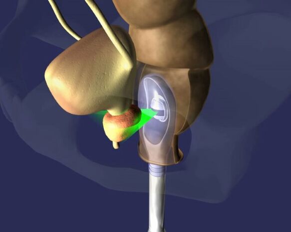 tratamento de ultrasóns da próstata para a prostatite