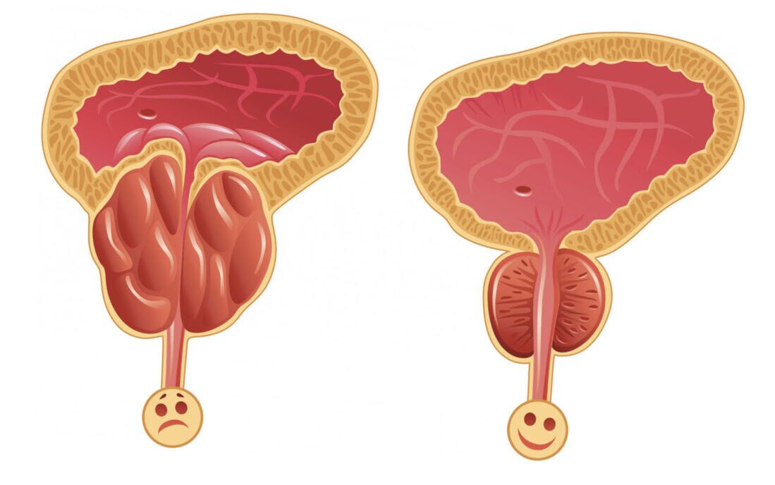 A inflamación da próstata con prostatite (esquerda) e da glándula prostática é normal (dereita)