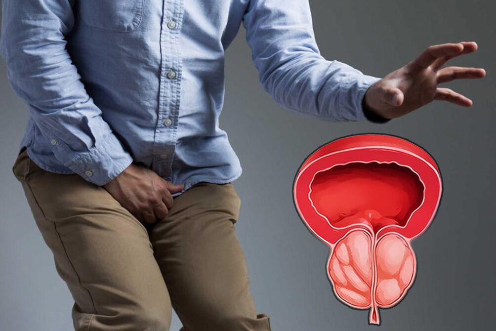Prostatite nun home que require tratamento inmediato